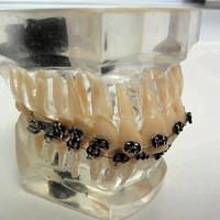 Zahnregulierung festsitzend