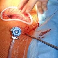 OP laparoskopisch (3)