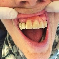VORHER   Prothese standard  (1)