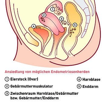ENDOMETRIOSE Aufklärungskampagne im März 2020