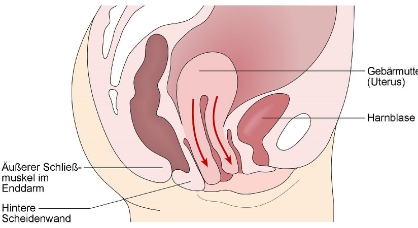 Senkung der Gebärmutter (Descensus uteri), Senkung der Harnblase (Cystocele), Senkung des Mastdarmes (Rectocele)