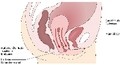 Senkung der Gebärmutter (Descensus uteri), Senkung der Harnblase (Cystocele), Senkung des Mastdarmes (Rectocele)