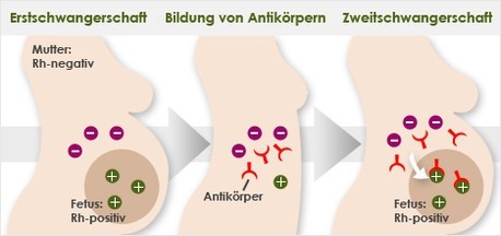 Rhesusfaktorbestimmung beim ungeborenen Kind während der Schwangerschaft